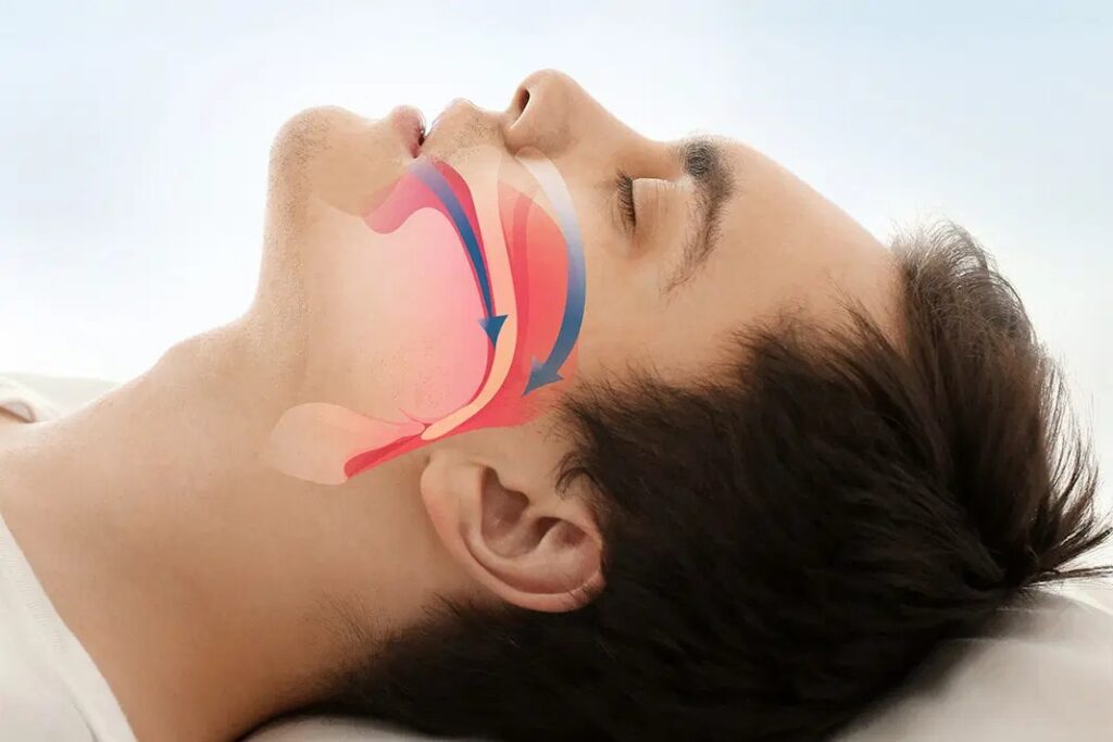 Upper Airway Resistance Syndrome